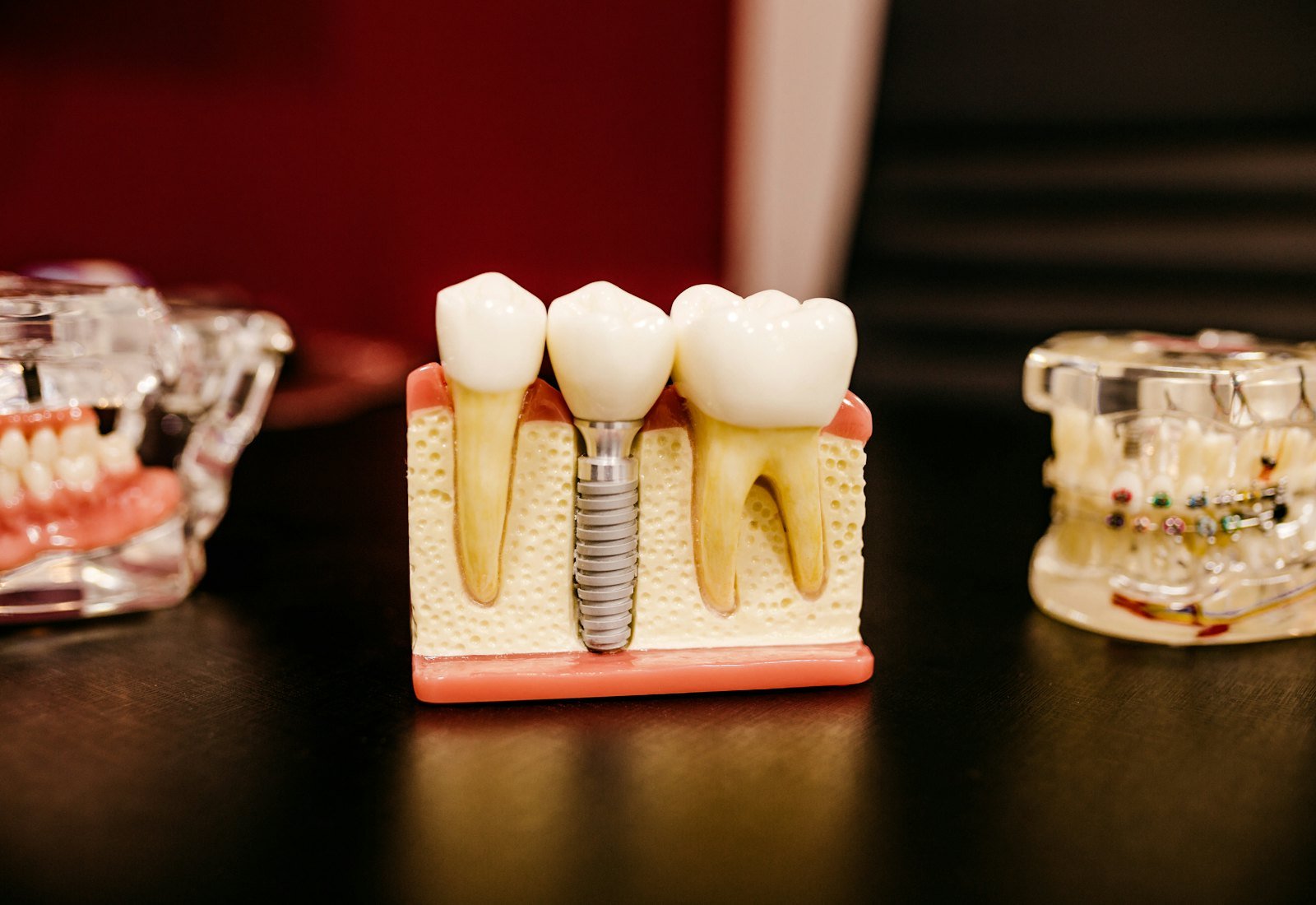 Modelo de implante dental con coronas